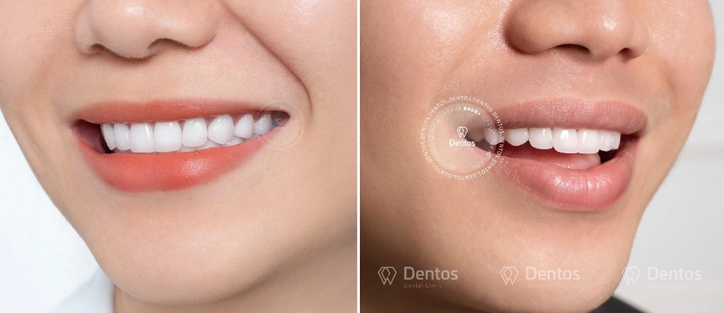 Dáng răng sứ nam sắc cạnh và to hơn nữ